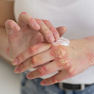 Rubbing ointment on a hand with psoriasis