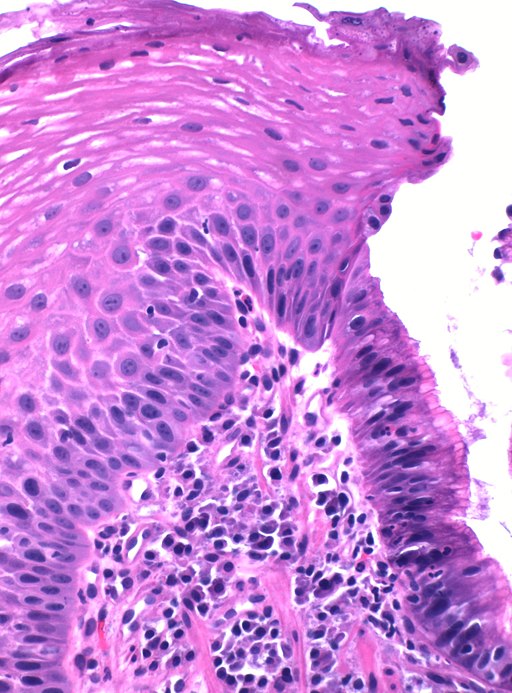 A histological picture of inflammation