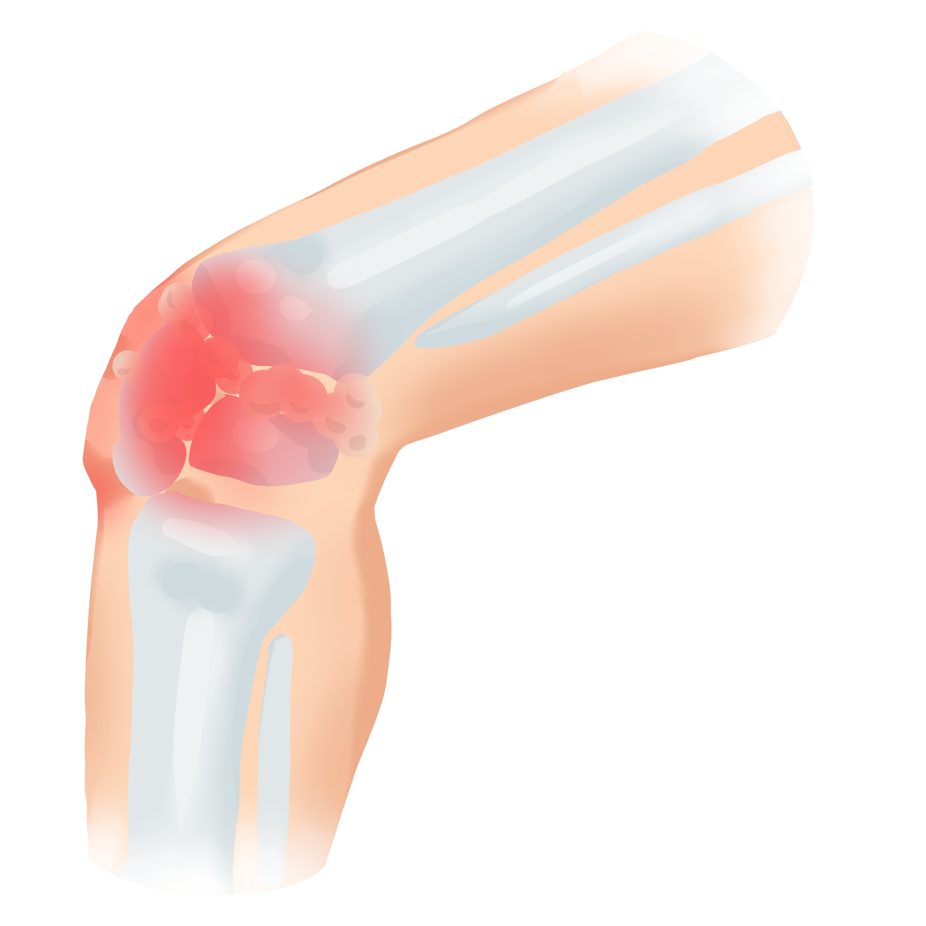 Illustration of osteoarthritis of the knee