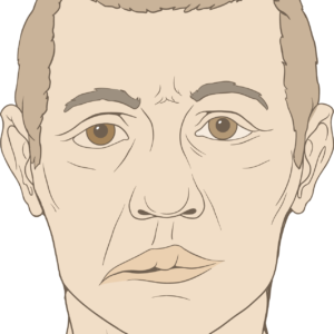 Illustration of a man with signs of Bells Palsy