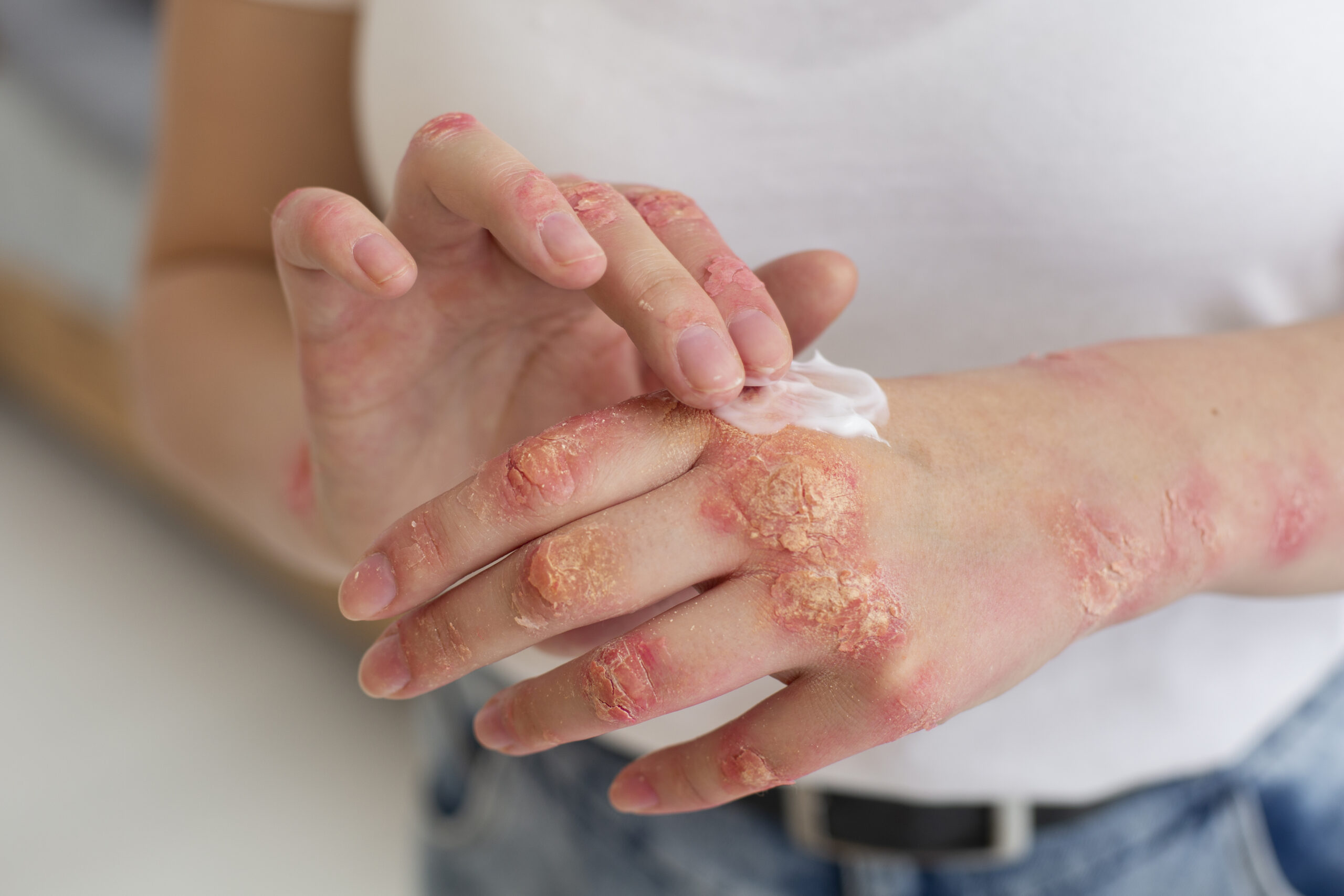 Woman putting ointment on psoriasis on her hand
